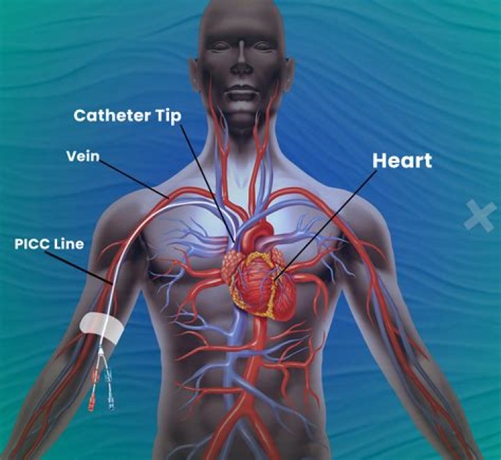 Is PICC line necessary
