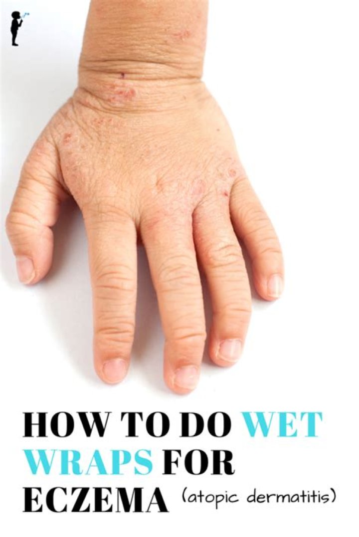 Should you wrap eczema